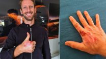 Grosjean reveals extent of burns to right hand